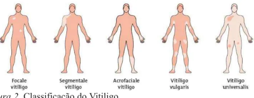 Figura 2. Classificação do Vitiligo