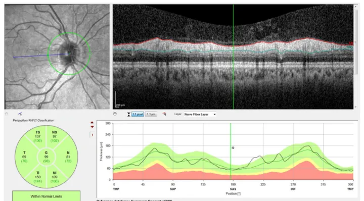Fig. 1  Thickness of the peripapillary retinal nerve fiber layer obtained by “RNFL Single Exam Report OU with FoDi ™ ” (Spectralis Heidelberg; μm)