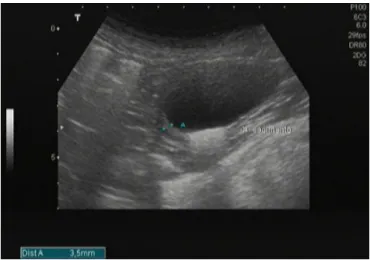 Figure 2: Side effects of long term allopurinol administration. Urinary sediment observed under abdominal  ultrasound exam