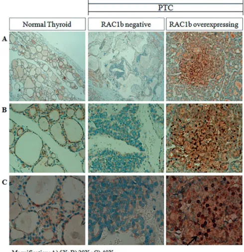 Fig 3. Immunohistochemical analysis of NF-kB in RAC1b-positive and RAC1b-negative PTC samples