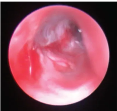 Figura  5  Otite  externa  perpetuada  pela  existência  de  otite  média.  Reproduzido  de  Paterson  S  Discovering  the  causes of otitis externa In Practice 2016;38:7-11, com a permissão de BMJ Publishing Group Ltd