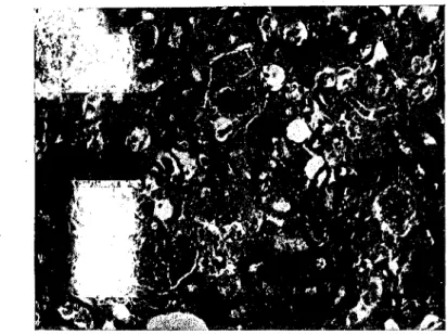 Fig. 4 — (Obs, X) —Acentuada necrose e intensa  descamação tubular 