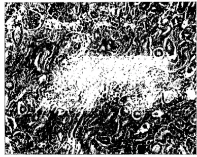 Fig. 5 — (Obs. XI) — Necrose dos tubos, em alguns dos quais se  notam núcleos picnóticos
