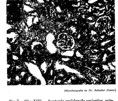 Fig, 7 —(Obs. XIII) — Acentuada proliferação conjuntiva, prin- prin-cipalmente nas zonas de desaparecimento tubular