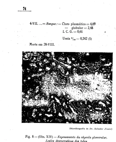 Fig. 8 — (Obs, XIV) — Espessamento da cápsula glomerular,  Lesões degenerativas dos tubos 