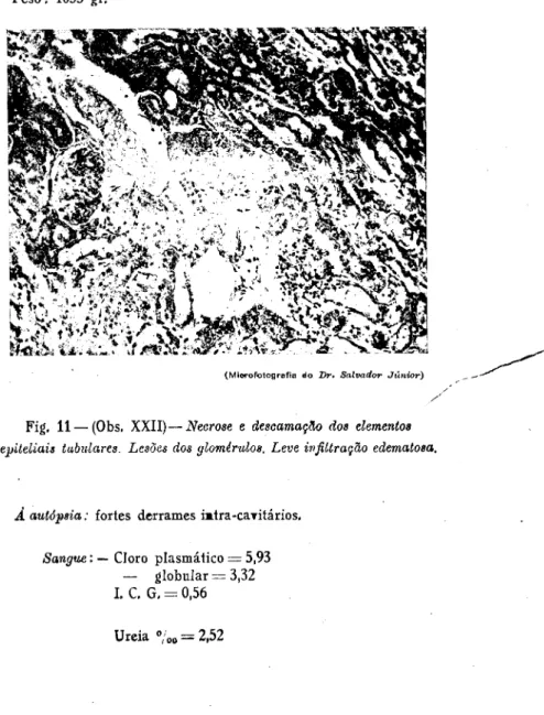 Fig. 11 — (Obs. XXII)— Necrose e descamaçHo dos elementos  epiteliais tabulares. Lesões dos ylomírulos