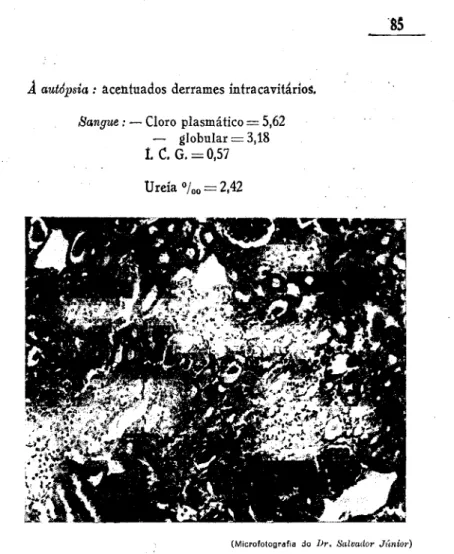 Fig, 13 — (Obs. XXIII)  —■ Necrose e degenerescência de grande  número de tubos. Cilindros hialinos