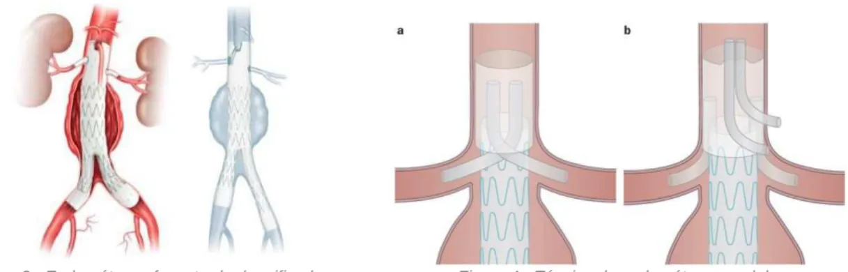 Figura 3 - Endopróteses fenestradas/ramificadas  Figura 4 - Técnica de endoprótese paralelas 
