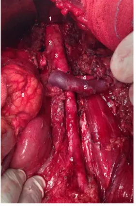 Figura 12 - Visualização intra-operatória de aneurisma da  aorta abdominal infra-renal 