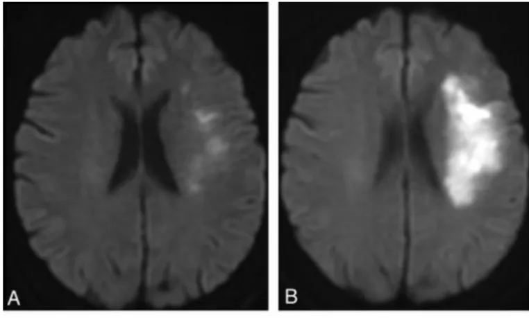 Figure 4 – MRI scans of 70 yeard old woman presenting stroke symptons, on admission (A) and after an follow up scan after  an  ischemic  event  (B)