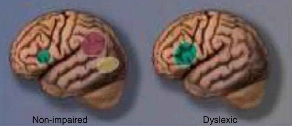 Figura 3 –  A assinatura neuronal da dislexia: hipo-ativação dos sistemas neuronais no lobo  temporo-posterior do cérebro (Fonte: Shaywitz, 2003, citado por Carvalho, 2011, p