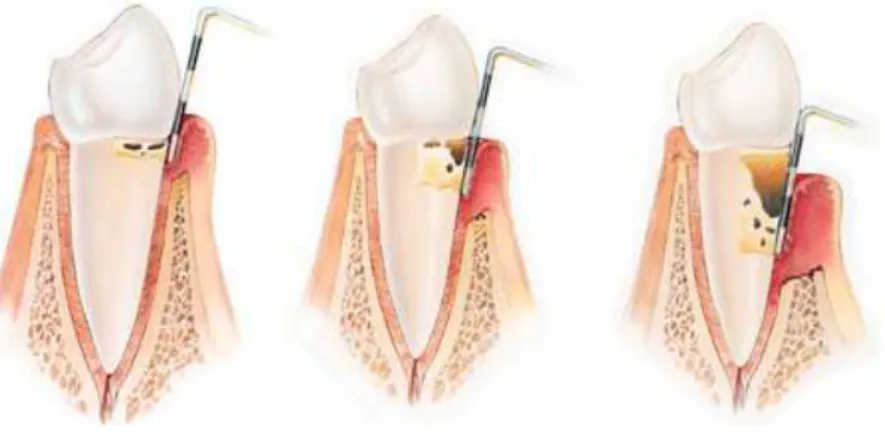 Figura 9 - Evolução da doença periodontal  Fonte: (Lindhe et al., 2010) 