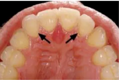 Figura 2. Erosão dentária nas faces palatinas dos dentes (Frydrych et al., 2005) 