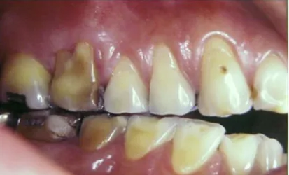 Figura 3. Erosão dentária nas faces vestibulares dos dentes posteriores (Branco et al., 2008) 