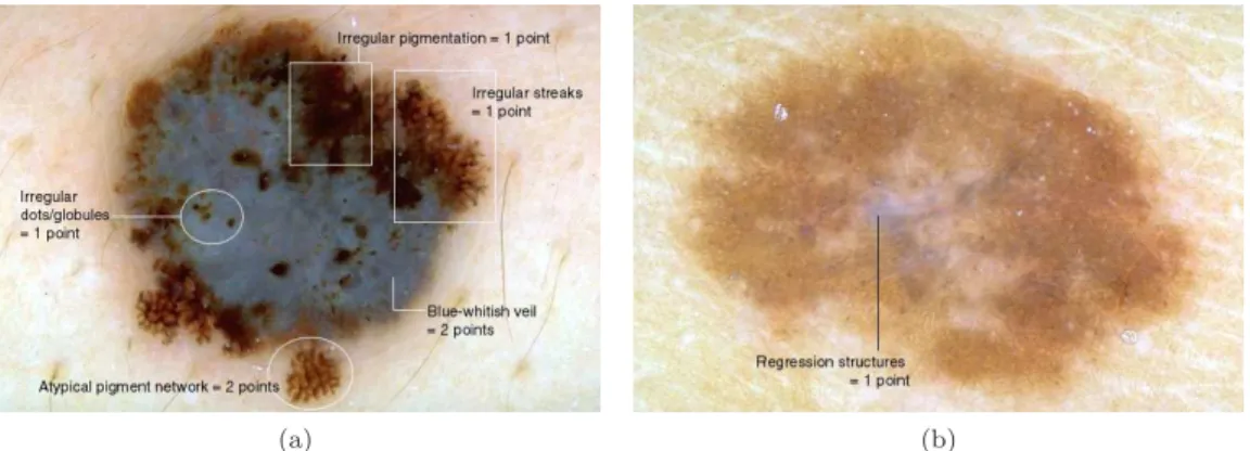 Figure 2.5 shows two examples of diagnosis using the 7-point point checklist. The pigmented skin lesion in Figure 2.5(a) corresponds to a melanoma, in which five dermoscopic characteristics can be identified, corresponding to a total score of 7