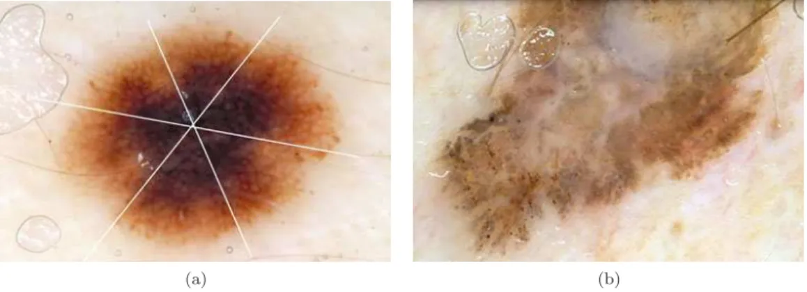Figure 2.6 illustrates two examples of the application of the Menzies method for diagnosing the melanocytic lesions