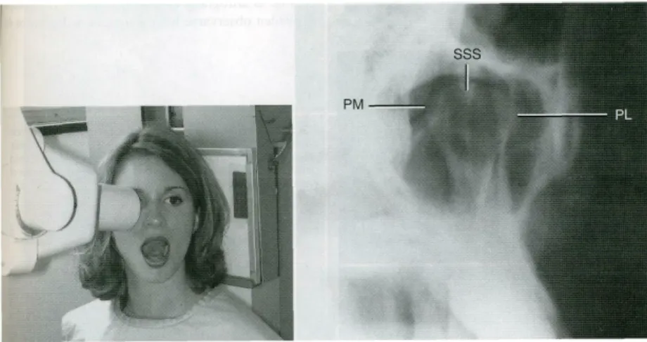 Fig. 15 - Radiografia transmaxilar. Posicionamento do feixe de RX, do porta- porta-película e do doente