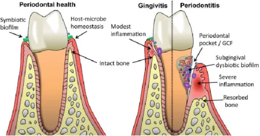 Figura 4: A simbiose microbiana na saúde periodontal e a disbióse na DP. (Hajishengallis, 2015)