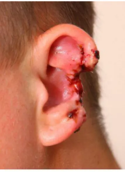 Figura 11 - Traumatismo provocado por dentada com avulsão de porção externa da orelha esquerda,  correspondente  à hélice