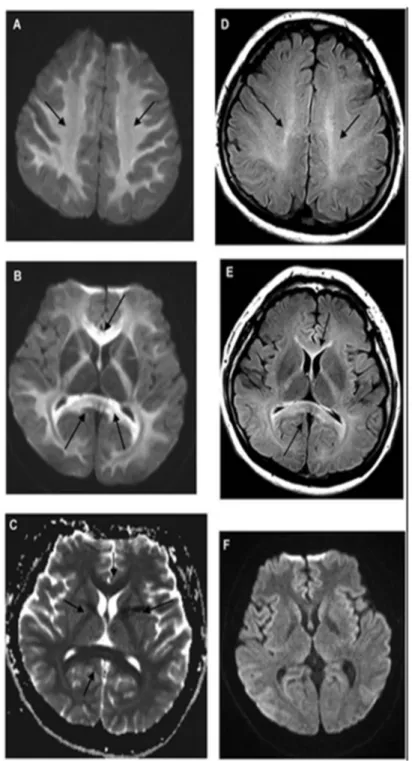 Figura 5.: Ressonância Magnética: as imagens apresentam um padrão de lesões simétricas revelado por  um hipersinal da substância branca (regiões brilhantes), característico da patologia em estudo e que revela  alterações metabólicas por exposição a uma sub