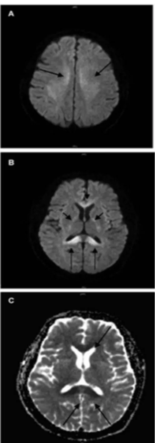 Figura 6.: Ressonância Magnética: (A) e (B) são imagens de difusão e (C) representa um mapa de  Coeficiente Aparente de Difusão (ADC)