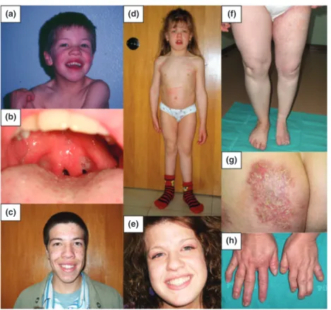 Fig. 1. Phenotypic features. Patient 1 (a) at diagnosis presented mildly coarse facial features with high forehead, epicanthic folds, low nasal bridge, broad nasal tip, full cheeks, large mouth with full lips and (b) bifid uvula (a feature present in sever