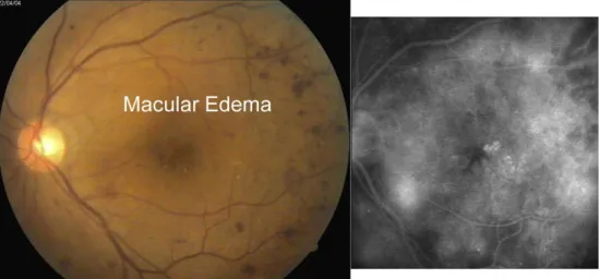 Ilustração  3  - Angiografia com  fluoresceina compatível com  RDNP e edema macular  (87) 