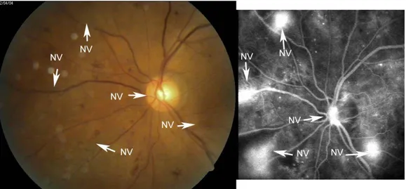 Ilustração  4  -  Angiografia  com  fluoresceína  compatível  com  RDP.  As  setas  indicam  formação de novos vasos no disco e noutro lugar (NVD e NVE) (86)