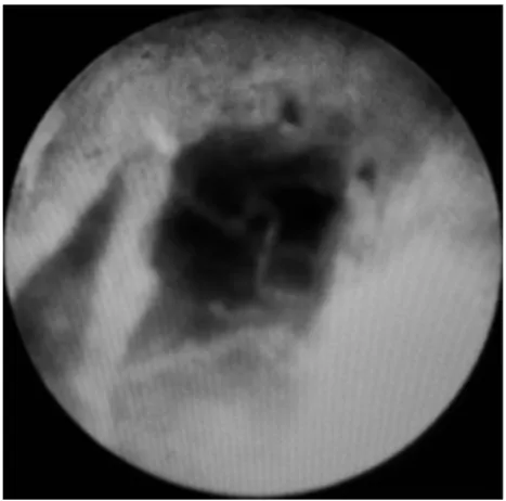 Figure 2. Epiduroscopic picture showing thick epidural fibrous septa on the left side of the image.