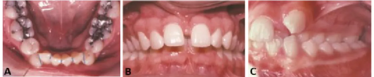 Figura 16. Exemplos de situações de comprometimentos estético e funcional. (A) Apinhamento dentário