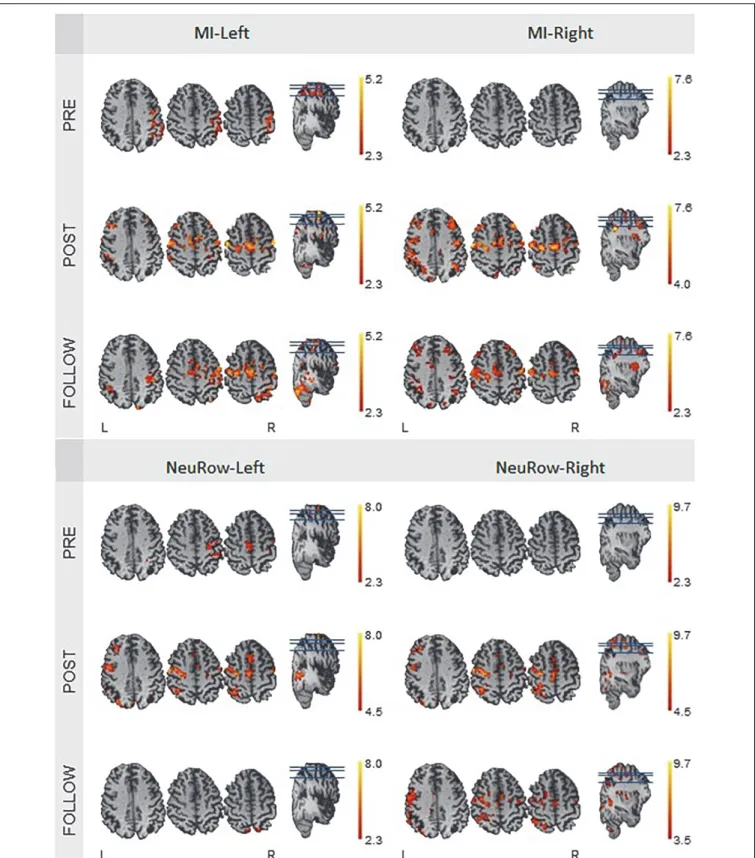 FIGURE 11 | fMRI activation maps of the motor imagery condition for the left and right hand, at the pre-intervention, post-intervention and follow-up recording sessions