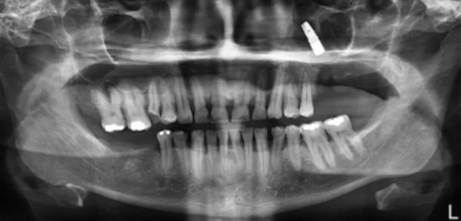 Figura 9 - Ortopantomografia com presença de implante no seio maxilar esquerdo (Adaptado a partir de  Cavezzi Junior &amp; Abdala Junior, 2013)