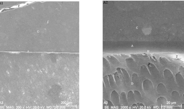 Figura  10  –  Microfotografias  obtidas  através  de  MEV  da  interface  adesiva  após  aplicação  do  sistema  adesivo no modo SE segundo o fabricante e com pressão pulpar – Grupo A