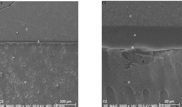 Figura  11  –  Microfotografias  obtidas  através  de  MEV  da  interface  adesiva  após  aplicação  de  Acetona  previamente ao sistema adesivo no modo SE e com pressão pulpar – Grupo C