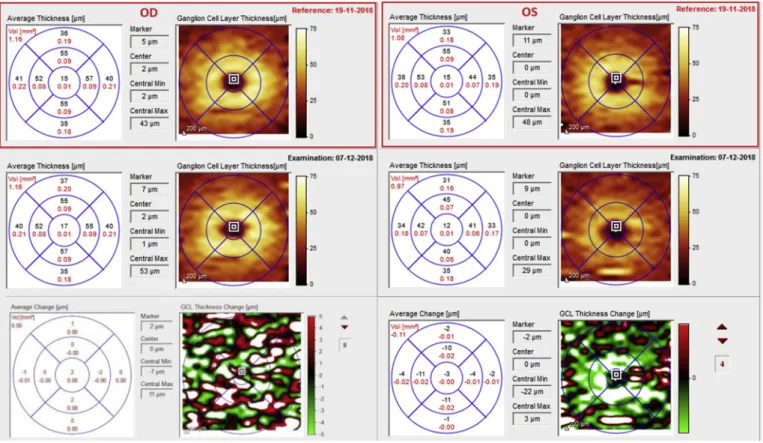 Fig. 5. Ganglion cell layer thickness analysis of both eyes at onset and three weeks later.