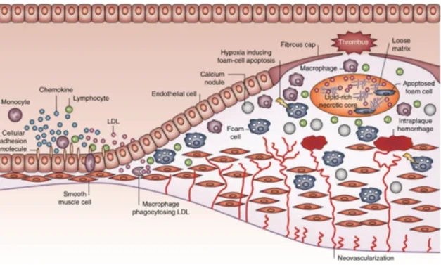 Figure 1.1: Atherosclerotic plaque development. The monocytes can adhere and pass through the endothelium, where they transform into macrophages and ingest the  for-eigner low-density lipoproteins, becoming foam cells that contribute to the narrowing of bl