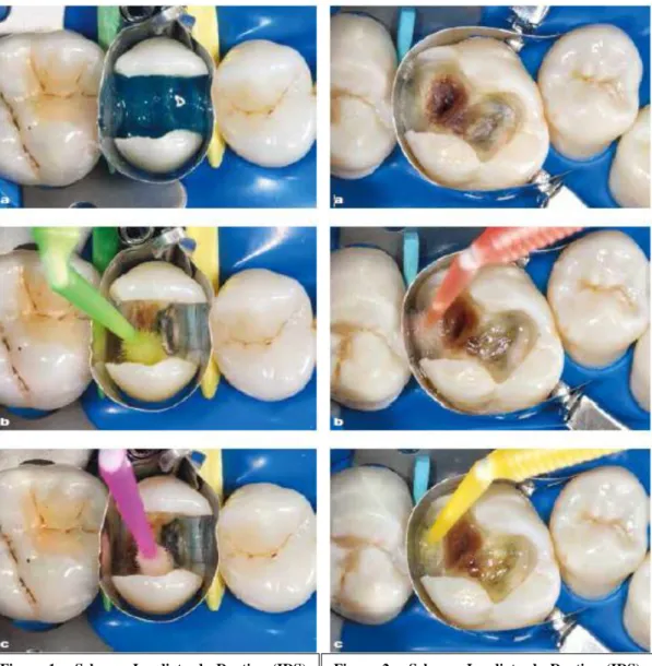 Figura  1  –  Selagem  Imediata  da  Dentina  (IDS)  com  recurso  a  um  sistema  adesivo   etch-and-rinse