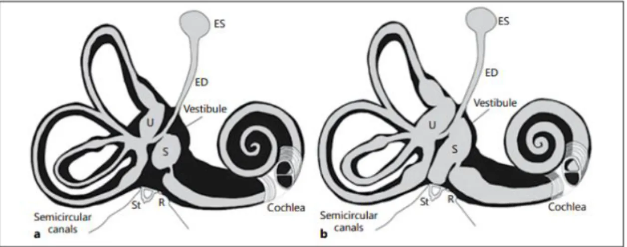 Figura 1 – Endolinfa e perilinfa no ouvido interno. (a) Normal. (b) Hidrópsia  endolinfática