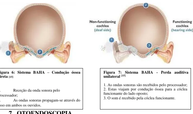Figura  7:  Sistema  BAHA  -  Perda  auditiva  unilateral  [15]