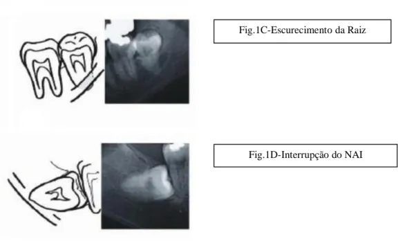 Figura 1 - Imagens sugestivas de relação próxima entre o terceiro molar mandibular inferior incluso e o nervo  alveolar inferior