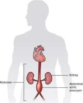Figure 1.1 - Abdominal aortic aneurysm. 