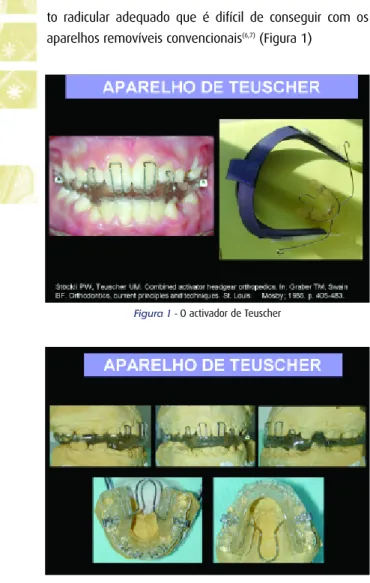 Figura 1 -  O activador de Teuscher