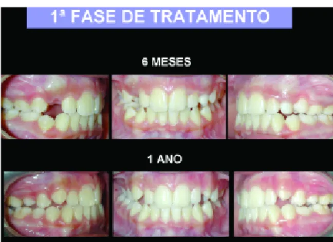 Figura 13 -  Vector da força inibitória que actua sobre a maxila