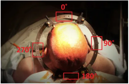 Figure 2.5: Stereotactic reference system attached to the patient’s head. Mounting positions for the stereotactic frame are indicated in red.