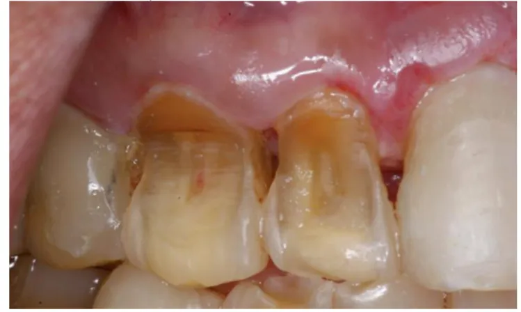 Figura 5 - Lesões de erosão dentária causada por ação de acido (What is the difference between dental  attrition, abfraction, erosion and abrasion, 2015) 