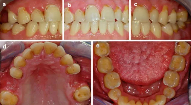 Figura 11 – Lesões de erosão dentária severas num paciente atingido de DRGE ( Amaechi, 2015)  