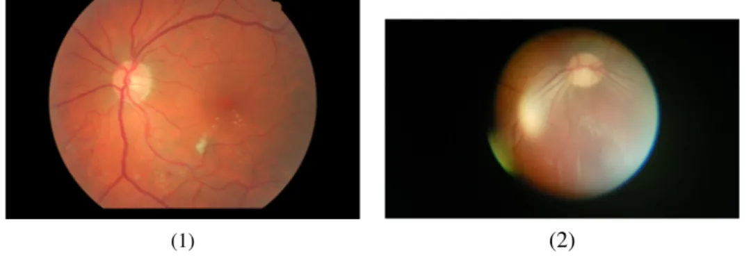 Figure 3.3: Retinographer and smartphone image used to test Quality Image Check algorithm.