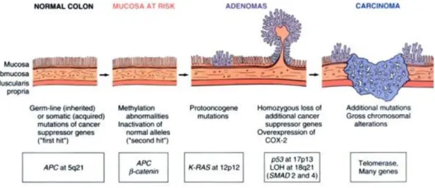 Figura  1:  Schematic  of  the  morphologic  and  molecular  changes  in  the  adenoma-carcinoma sequence