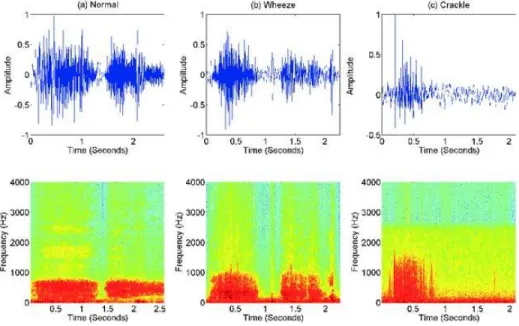 Fig. 3 - Time-domain characteristics and spectrogram of (a) normal, (b) wheeze, and (c) crackle lung sound cycle [7]