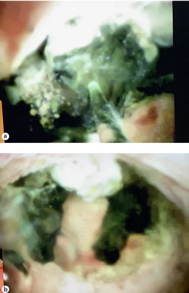 Fig. 1.  Cholangioscopy-guided laser lithotripsy of a large bile duct  stone.  a  Laser fiber and green aiming beam targeting the stone